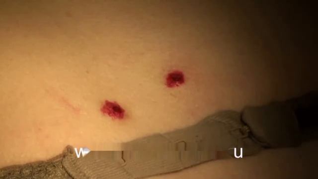 Удаление родинок невусов смотреть онлайн