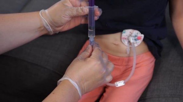 Bolus Feeding by Syringe—Gravity Method