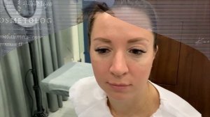 Коррекция Филлером НОСОСЛЕЗНОЙ БОРОЗДЫ ?? ФИЛЛЕР под Глаза ? Как убрать НОСОСЛЕЗНУЮ БОРОЗДУ