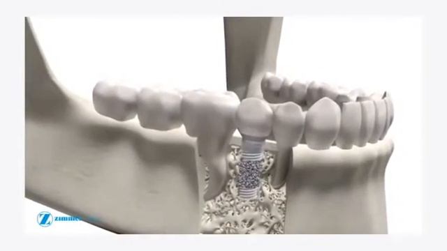 МедиДент Имплантанты - как это делается смотреть онлайн