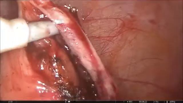 Лапароскопия при Хроническом Аппендиците