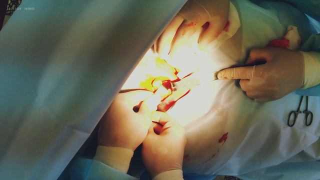 Операция - удаление ЛИПОМЫ задней поверхности шеи