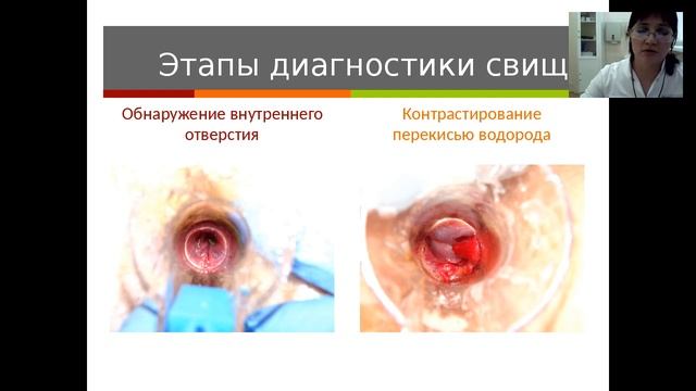 «Свищ заднего прохода. Часть 2», вебинар 17.10.2016 смотреть онлайн