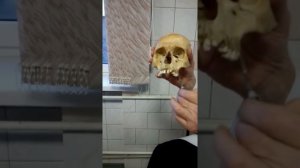 Анестезии на верхней челюсти