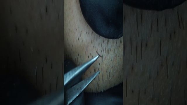 Пинцетом для удаления вросшей бороды For IPhone 2020/11/15