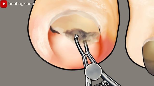 [ASMR] Athlete's Foot Treatment Animation/Care For Neglected Athlete's Foot Toenails / Asmr