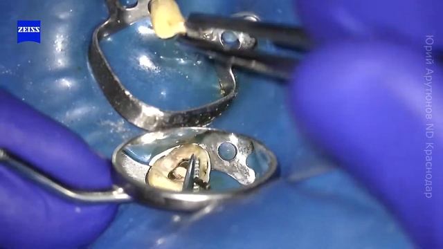 Извлечение штифта. Перелечивание. Закрытие перфорации. Установка СВШ смотреть онлайн