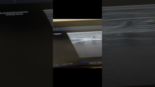 Результат операции по удалению варикоза. Лечение варикоза. Флеболог. Флеболог Москва. Узи сосудов смотреть онлайн