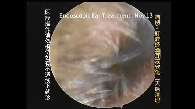 Clearance Of Cerumen And Follow-up Examination Of Cholesteatoma 20231113