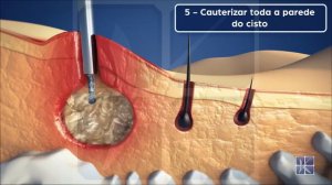 EPSIT (Endoscopic Pilonidal Sinus Treatment) - Tratamento Endoscópico do Cisto Pilonidal