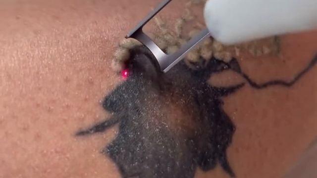 Видаляємо татуювання безпечно і з гарантією ? смотреть онлайн