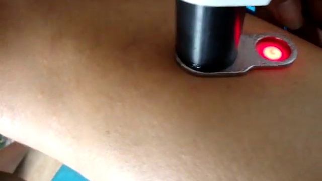 1064nm long pulse laser treatment test смотреть онлайн