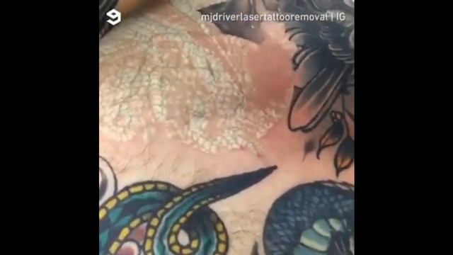 Amazing Tatoo Removal | Laser Tattoo Removal