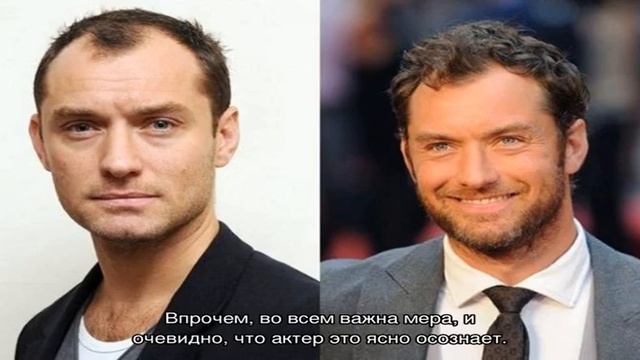 Знаменитые мужчины, которые решились на пересадку волос смотреть онлайн