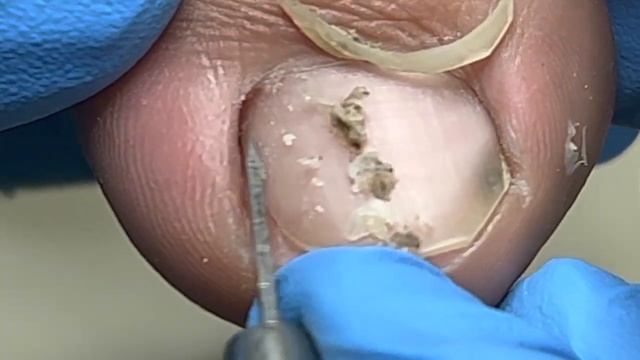 Dirt Is Hidden In The Corners Of The Toenails!【Xue Yidao Pedicure】