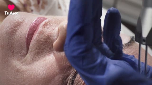 Лазерная шлифовка кожи лица CO2 лазером смотреть онлайн