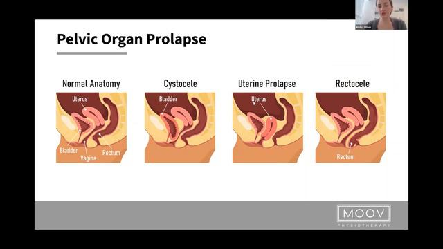 My Pelvic What?? An Educational Webinar on Pelvic Health with MOOV Physiotherapy Ottawa смотреть онлайн