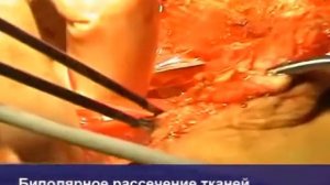 Резекция сигмовидной кишки