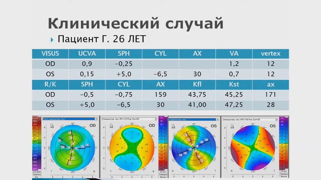 Коррекция смешанного астигматизма Полунина Е В смотреть онлайн