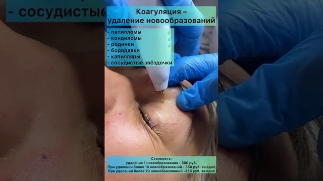 Коагуляция. Удаление новообразований. Папилломы. Родинки. Бородавки. смотреть онлайн