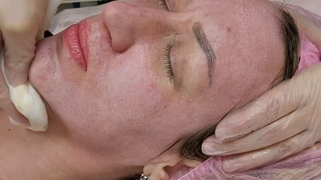 АирисКом студенты учатся: семинар по химическому пилингу ТСА 25% смотреть онлайн