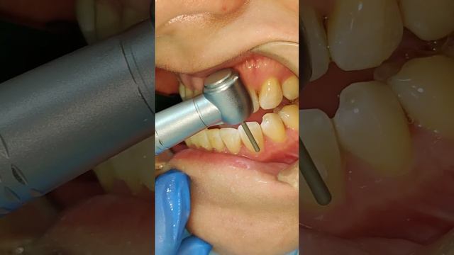 Результат после элайнеров #стоматологалматы #брекетыалматы смотреть онлайн
