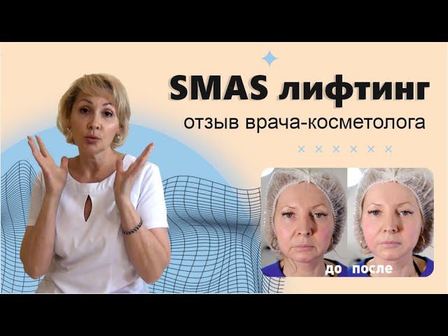 SMAS лифтинг. Отзыв врача о подтяжке лица и разбор результатов. Демонстрация SMAS лифтинг Москва.