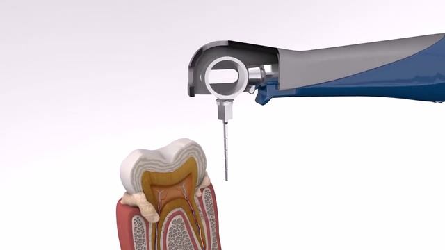 Процедура чистки карманов аппаратом Vector