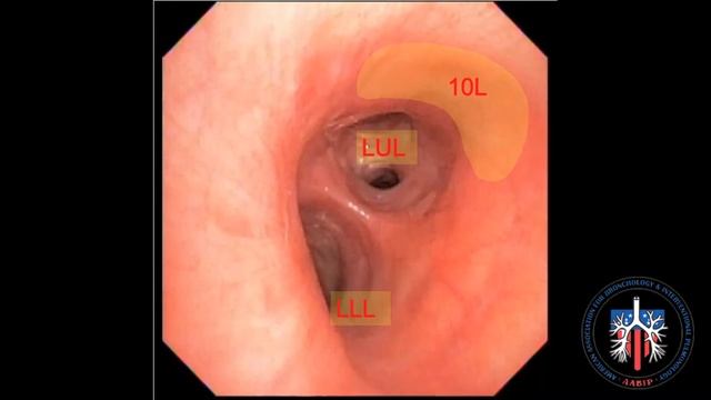 EBUS Lymph Node Station 10L смотреть онлайн