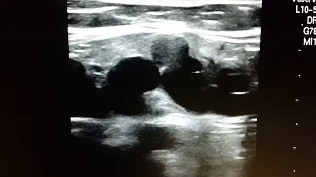 Ultrasound of recurrent varicose. Neovascularization. Рецидив варикозной болезни после венэктомии смотреть онлайн