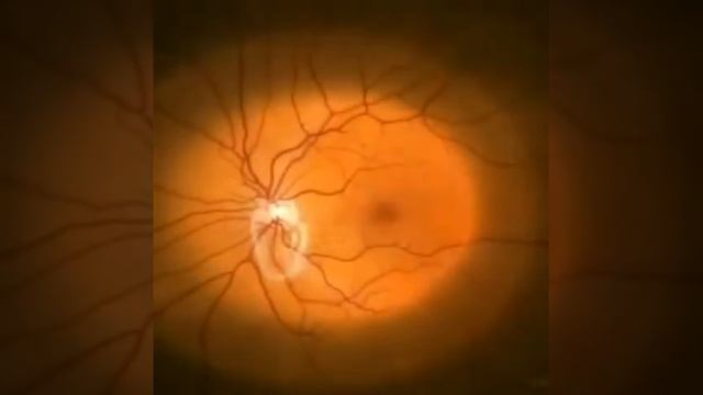 Отслоение сетчатки глаза. Что это такое? смотреть онлайн