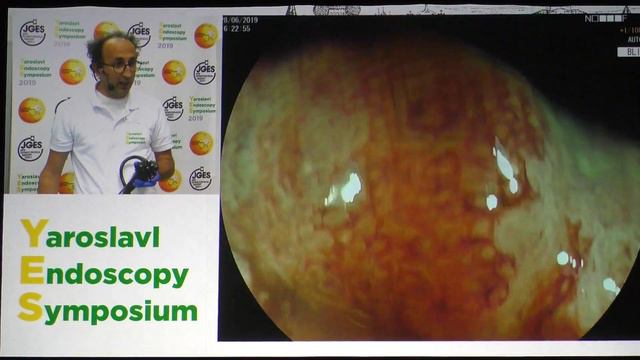 17Live Hassan Cesare Татуаж рака толстой кишки T2N0M0 смотреть онлайн