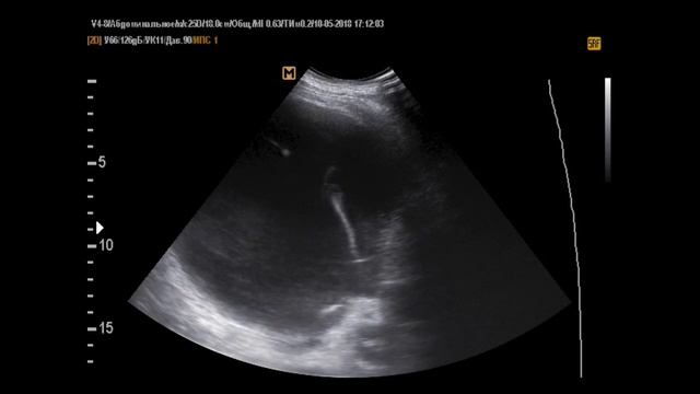 Жидкость в плевральной полости на УЗИ плевральной полости (14-8-19) смотреть онлайн