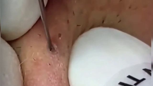 Lips Blackhead Extraction | Big Blackhead #blackheads #acne #pimple