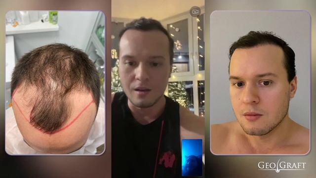 Пересадка волос в Москве, отзыв пациента GeoGraft) цена 120 тыс.₽ смотреть онлайн