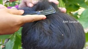 Psoriasis treatment   Big Flakes, Dandruff Scratching #112