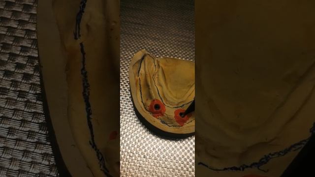 Не держится съемный протез??Решение имплантаты . смотреть онлайн