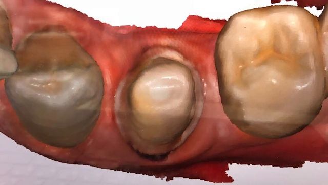 Изготовление коронки с применением интраорального сканера MEDIT i500 intraoral scanner смотреть онлайн