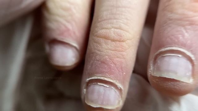 Онихофагия Что это? Часть 2 / Как лечить? / Грызет ногти подросток / Поможет наращивание грызуну? смотреть онлайн