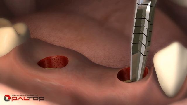 ПОЛНЫЙ ХИРУРГИЧЕСКИЙ ПРОТОКОЛ С ВИРТУАЛЬНЫМ ПЛАНИРОВАНИЕМ смотреть онлайн
