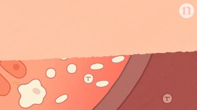 Ulcerative colitis: Fresh approaches to taming inflammation смотреть онлайн