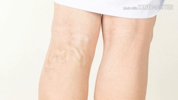 Varikoz kasalligi,kelib chiqish sabablari,davolash