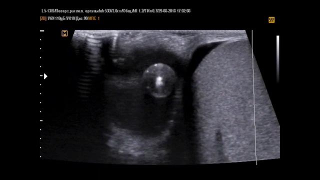 УЗИ мошонки - Скротолит интересный (29-8-18) смотреть онлайн