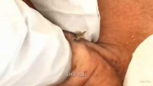 УГРИ ЗА УХОМ , УДАЛЕНИЕ ЧЕРНЫХ ТОЧЕК , ЖЕСТЬ ВИДЕО, АКНЕ, ЧИСТКА ЛИЦА ОТ