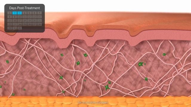 TempSure Envi для уменьшения морщин и подтяжки кожи