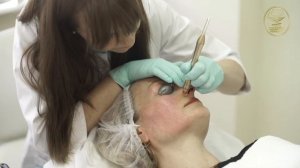 Лазерное удаление сосудов