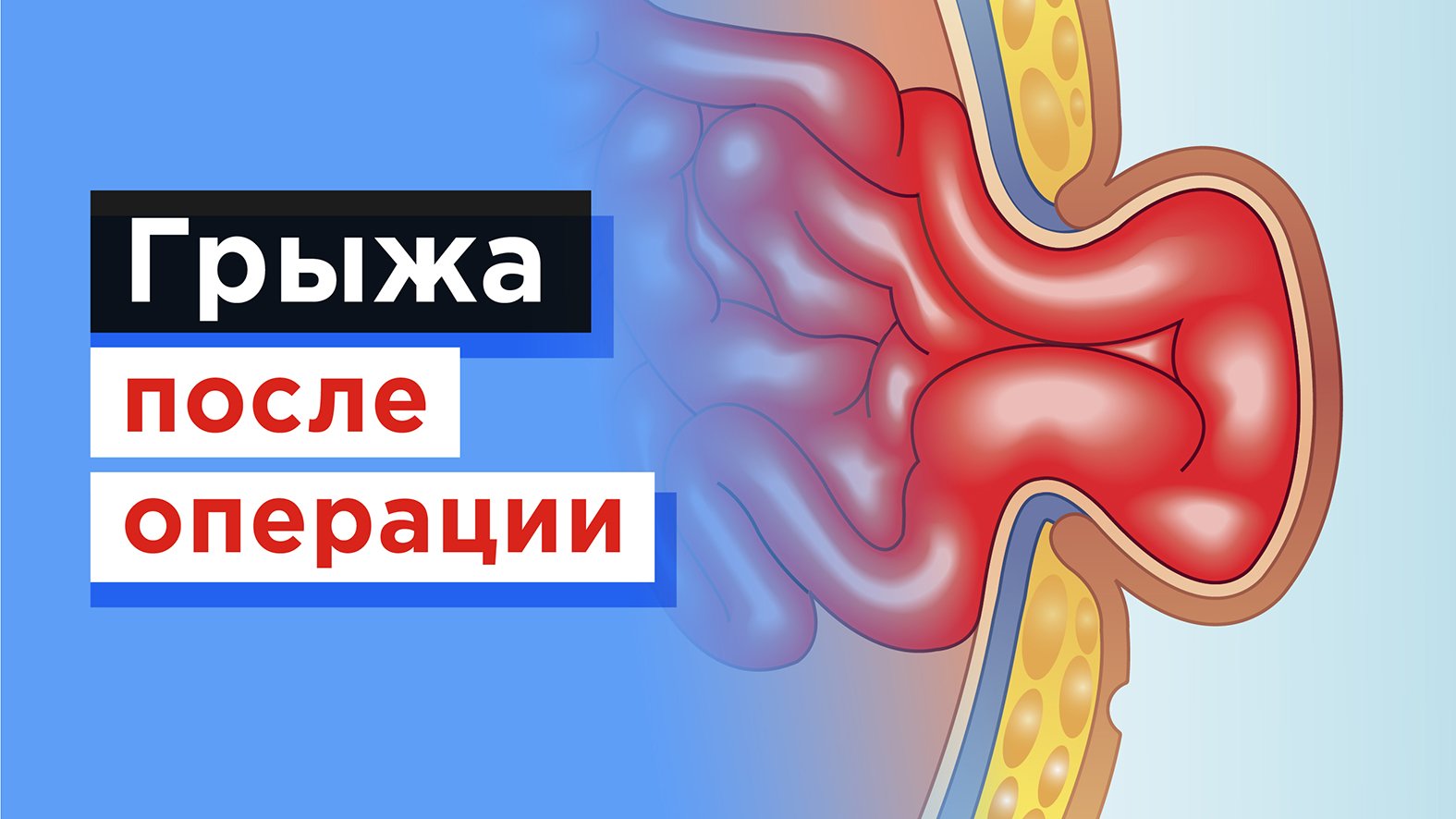 Удаление троакарной грыжи (грыжи после операции) по ОМС смотреть онлайн