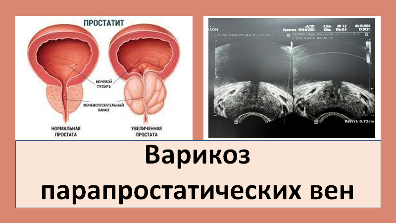 Варикоз парапростатических вен смотреть онлайн