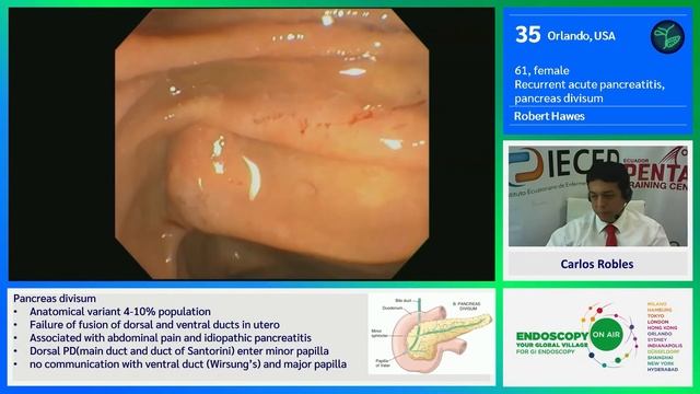 36. Орландо. Рецидивирующий острый панкреатит. Разделение поджелудочной железы. Роберт Хос