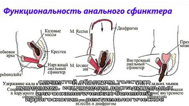 Симптомы и лечение спазма сфинктера прямой кишки смотреть онлайн